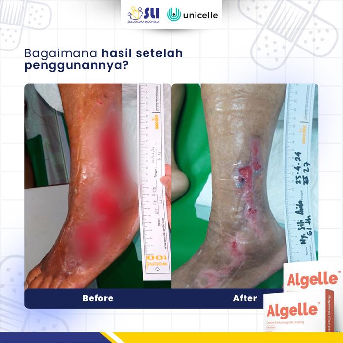 1 BOX ALGELLE CALCIUM 10CM X 20CM - ALGINATE DRESSING