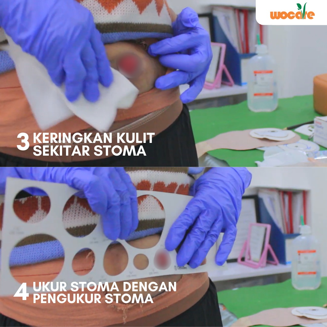 LAYANAN PERAWATAN STOMA GRATIS