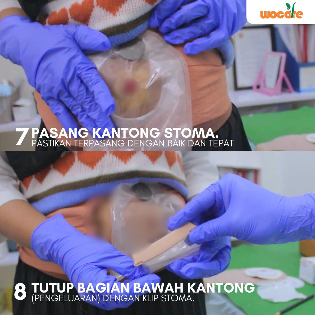 LAYANAN PERAWATAN STOMA GRATIS